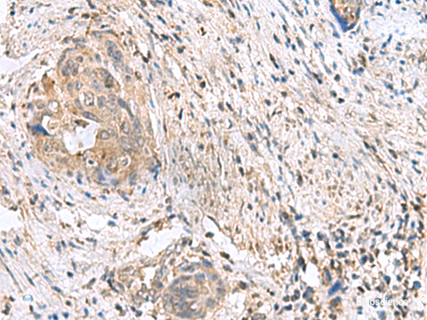 Immunohistochemistry of paraffin-embedded Human cervical cancer tissue using STK32A Polyclonal Antibody at dilution of 1:90(×200)