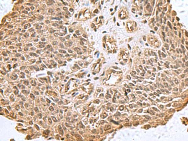 Immunohistochemistry of paraffin-embedded Human lung cancer tissue using DCTPP1 Polyclonal Antibody at dilution of 1:80(×200)