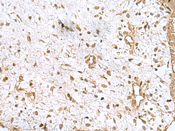 Immunohistochemistry of paraffin-embedded Human breast cancer tissue using AK6 Polyclonal Antibody at dilution of 1:90(×200)