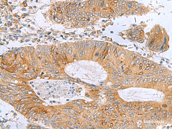 Immunohistochemistry of paraffin-embedded Human colorectal cancer tissue using TXNDC12 Polyclonal Antibody at dilution of 1:60(×200)