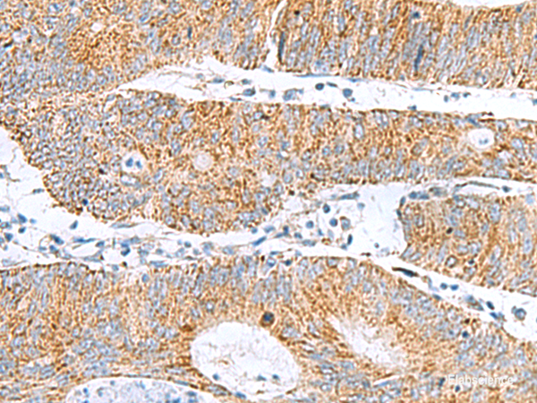 Immunohistochemistry of paraffin-embedded Human colorectal cancer tissue using GCSH Polyclonal Antibody at dilution of 1:60(×200)