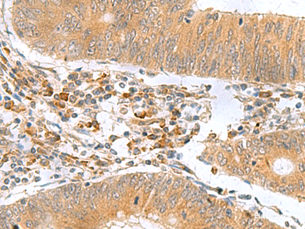 Immunohistochemistry of paraffin-embedded Human colorectal cancer tissue using MYDGF Polyclonal Antibody at dilution of 1:65(×200)
