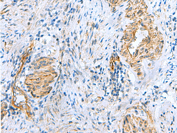 Immunohistochemistry of paraffin-embedded Human cervical cancer tissue using NMU Polyclonal Antibody at dilution of 1:60(×200)