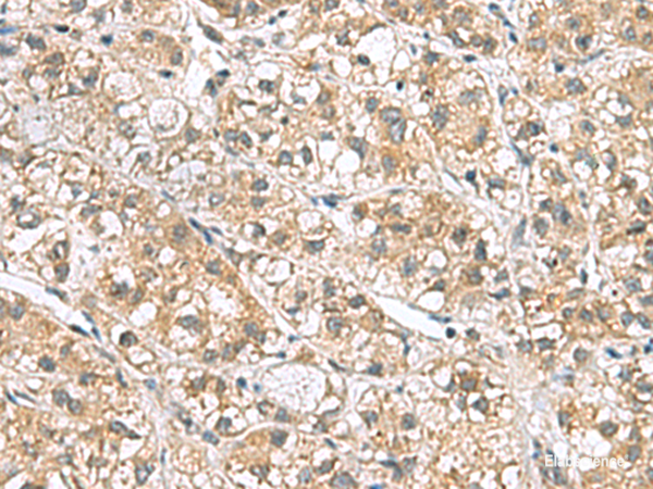Immunohistochemistry of paraffin-embedded Human liver cancer tissue using PPIH Polyclonal Antibody at dilution of 1:70(×200)