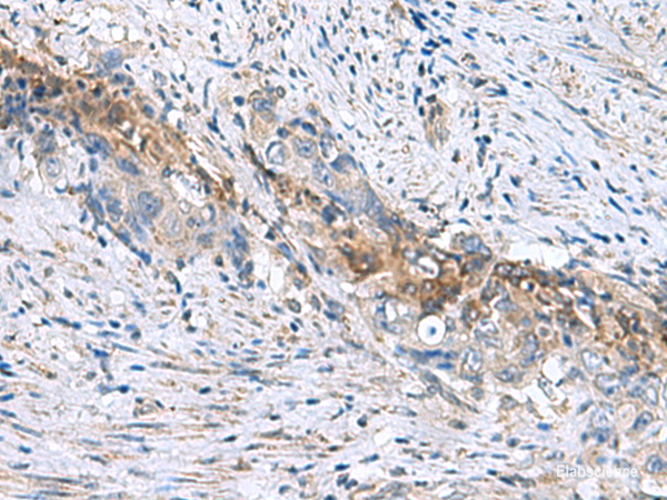 Immunohistochemistry of paraffin-embedded Human cervical cancer tissue using RNF208 Polyclonal Antibody at dilution of 1:55(×200)