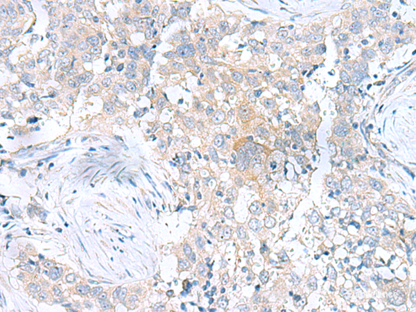Immunohistochemistry of paraffin-embedded Human esophagus cancer tissue using UBE2F Polyclonal Antibody at dilution of 1:100(×200)