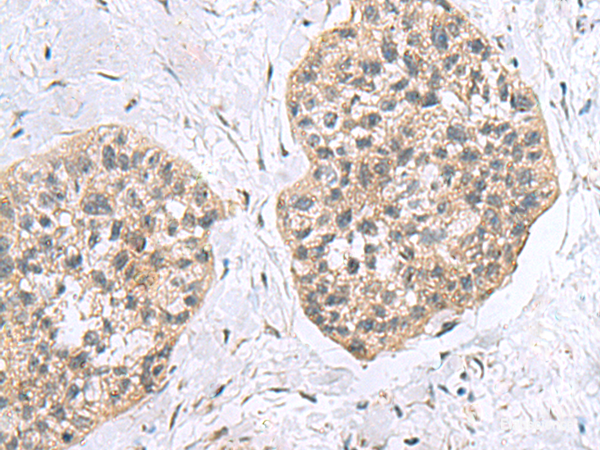 Immunohistochemistry of paraffin-embedded Human esophagus cancer tissue using RPL18 Polyclonal Antibody at dilution of 1:60(×200)