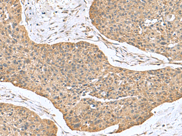 Immunohistochemistry of paraffin-embedded Human esophagus cancer tissue using CSRP2 Polyclonal Antibody at dilution of 1:70(×200)
