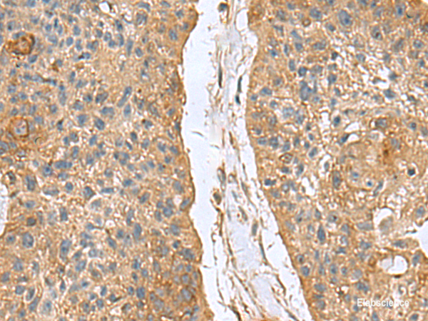 Immunohistochemistry of paraffin-embedded Human esophagus cancer tissue using MARCKSL1 Polyclonal Antibody at dilution of 1:70(×200)