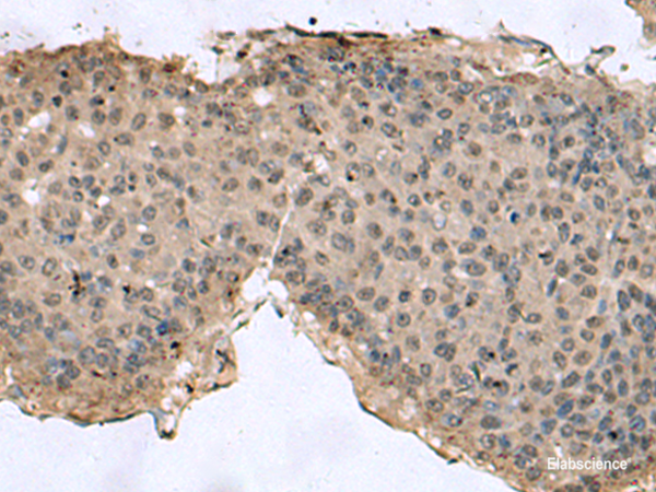 Immunohistochemistry of paraffin-embedded Human liver cancer tissue using TMX3 Polyclonal Antibody at dilution of 1:60(×200)