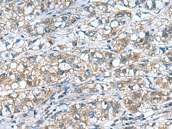 Immunohistochemistry of paraffin-embedded Human liver cancer tissue using COMMD9 Polyclonal Antibody at dilution of 1:55(×200)