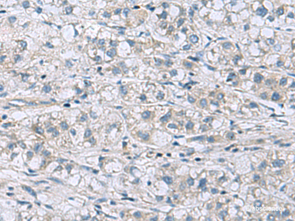 Immunohistochemistry of paraffin-embedded Human liver cancer tissue using ITGB1BP1 Polyclonal Antibody at dilution of 1:60(×200)