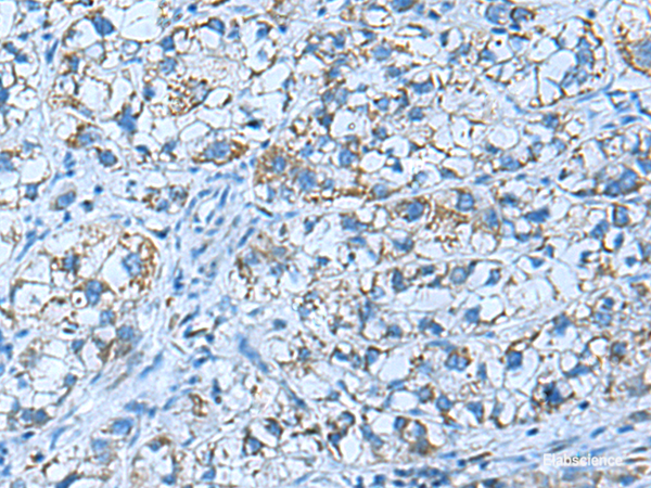 Immunohistochemistry of paraffin-embedded Human liver cancer tissue using GUCA1A Polyclonal Antibody at dilution of 1:50(×200)