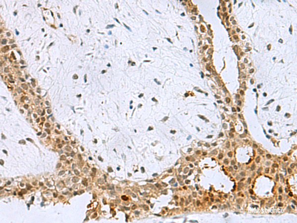 Immunohistochemistry of paraffin-embedded Human breast cancer tissue using BCL7B Polyclonal Antibody at dilution of 1:60(×200)