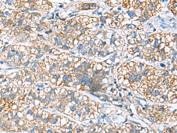 Immunohistochemistry of paraffin-embedded Human liver cancer tissue using JOSD1 Polyclonal Antibody at dilution of 1:90(×200)