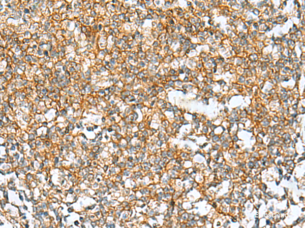 Immunohistochemistry of paraffin-embedded Human tonsil tissue using RAB13 Polyclonal Antibody at dilution of 1:50(×200)