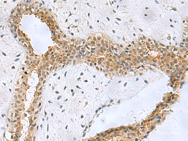 Immunohistochemistry of paraffin-embedded Human breast cancer tissue using NABP1 Polyclonal Antibody at dilution of 1:50(×200)