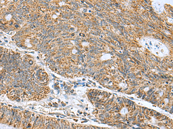 Immunohistochemistry of paraffin-embedded Human colorectal cancer tissue using MRPL40 Polyclonal Antibody at dilution of 1:50(×200)