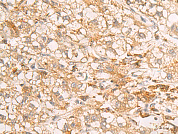 Immunohistochemistry of paraffin-embedded Human liver cancer tissue using RAB38 Polyclonal Antibody at dilution of 1:50(×200)