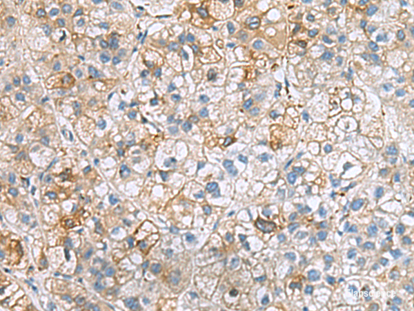 Immunohistochemistry of paraffin-embedded Human liver cancer tissue using IGLL1 Polyclonal Antibody at dilution of 1:50(×200)