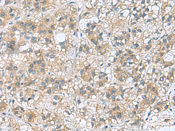 Immunohistochemistry of paraffin-embedded Human liver cancer tissue using RAB39A Polyclonal Antibody at dilution of 1:70(×200)