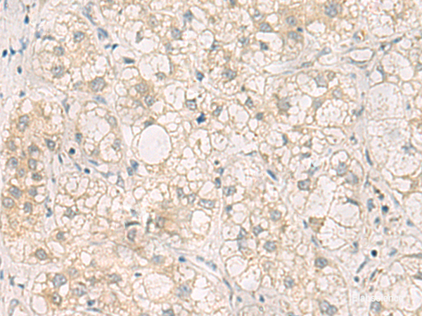 Immunohistochemistry of paraffin-embedded Human liver cancer tissue using LRAT Polyclonal Antibody at dilution of 1:50(×200)