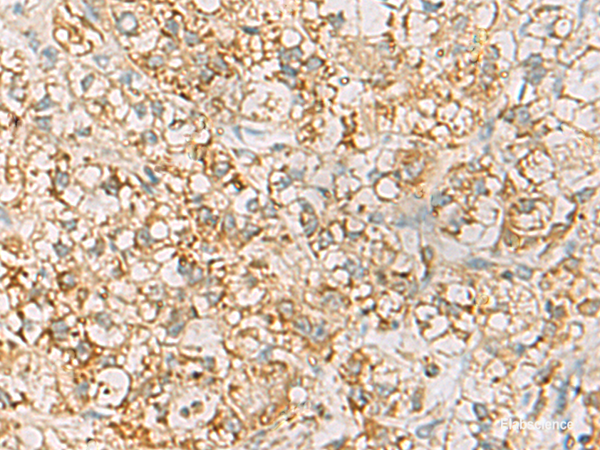 Immunohistochemistry of paraffin-embedded Human liver cancer tissue using HLA-DQB2 Polyclonal Antibody at dilution of 1:70(×200)