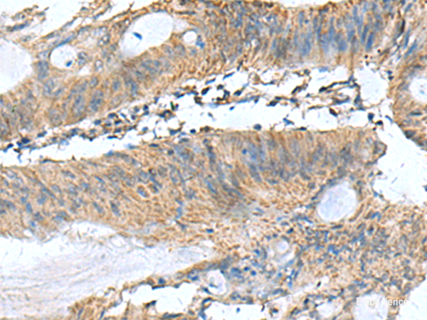 Immunohistochemistry of paraffin-embedded Human colorectal cancer tissue using PAFAH1B3 Polyclonal Antibody at dilution of 1:60(×200)