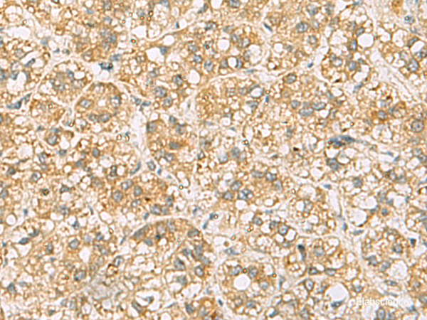 Immunohistochemistry of paraffin-embedded Human liver cancer tissue using FAAP100 Polyclonal Antibody at dilution of 1:65(×200)