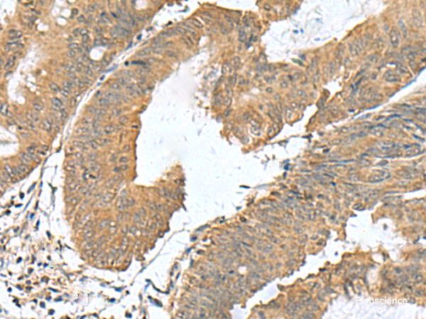 Immunohistochemistry of paraffin-embedded Human colorectal cancer tissue using RAB23 Polyclonal Antibody at dilution of 1:50(×200)