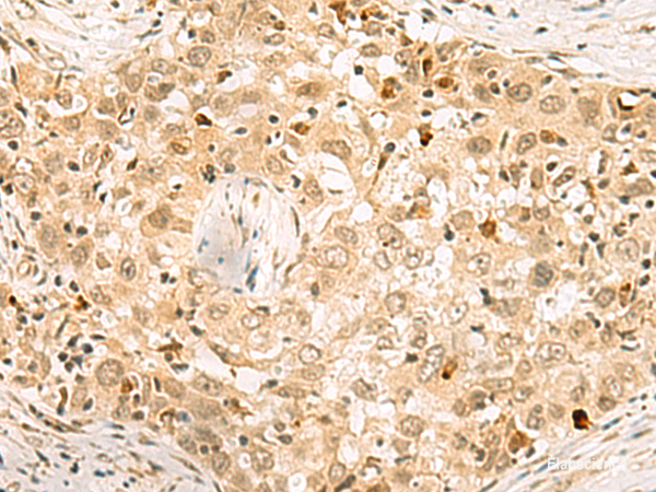 Immunohistochemistry of paraffin-embedded Human esophagus cancer tissue using EXOSC4 Polyclonal Antibody at dilution of 1:70(×200)