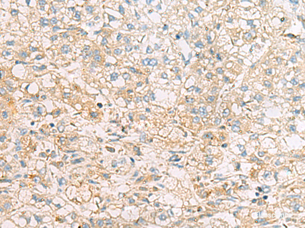 Immunohistochemistry of paraffin-embedded Human liver cancer tissue using EIF4E2 Polyclonal Antibody at dilution of 1:50(×200)