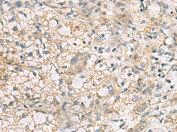 Immunohistochemistry of paraffin-embedded Human liver cancer tissue using RTP4 Polyclonal Antibody at dilution of 1:50(×200)