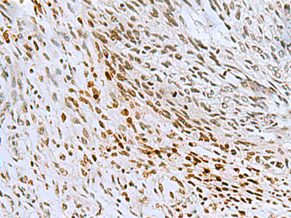 Immunohistochemistry of paraffin-embedded Human lung cancer tissue using CNOT7 Polyclonal Antibody at dilution of 1:55(×200)