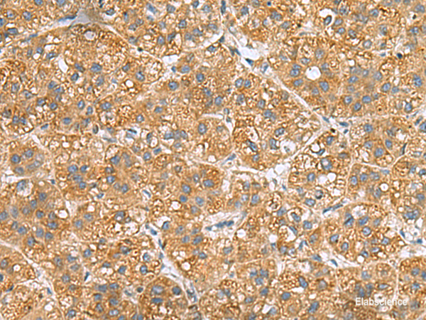 Immunohistochemistry of paraffin-embedded Human liver cancer tissue using PPM1M Polyclonal Antibody at dilution of 1:50(×200)