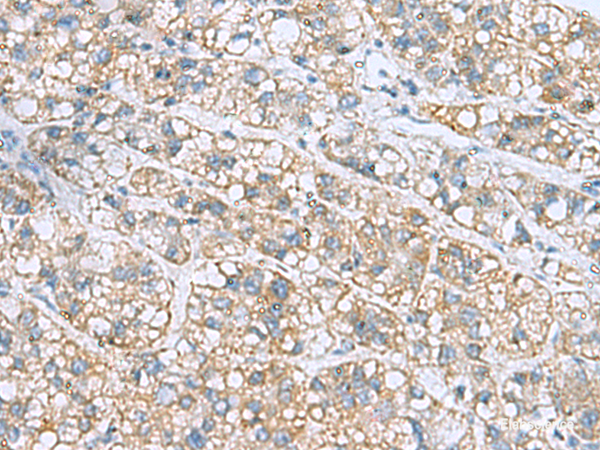 Immunohistochemistry of paraffin-embedded Human liver cancer tissue using NANP Polyclonal Antibody at dilution of 1:50(×200)