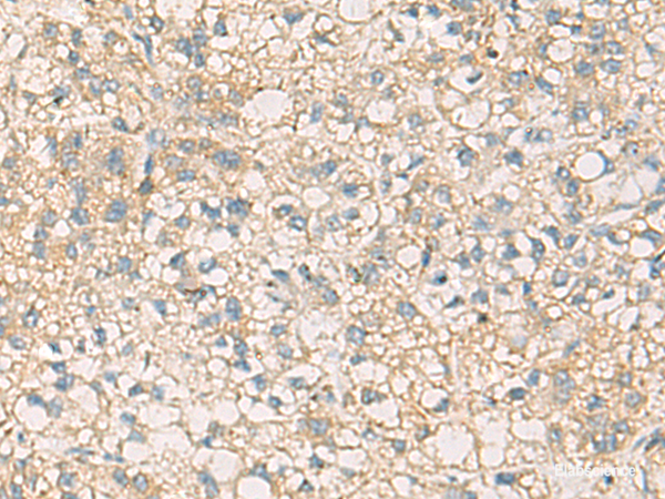 Immunohistochemistry of paraffin-embedded Human liver cancer tissue using STX6 Polyclonal Antibody at dilution of 1:45(×200)