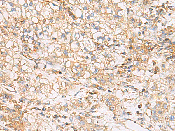 Immunohistochemistry of paraffin-embedded Human liver cancer tissue using FYCO1 Polyclonal Antibody at dilution of 1:60(×200)
