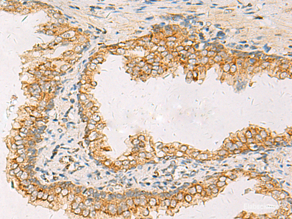Immunohistochemistry of paraffin-embedded Human prost at e cancer tissue using SUSD3 Polyclonal Antibody at dilution of 1:85(×200)
