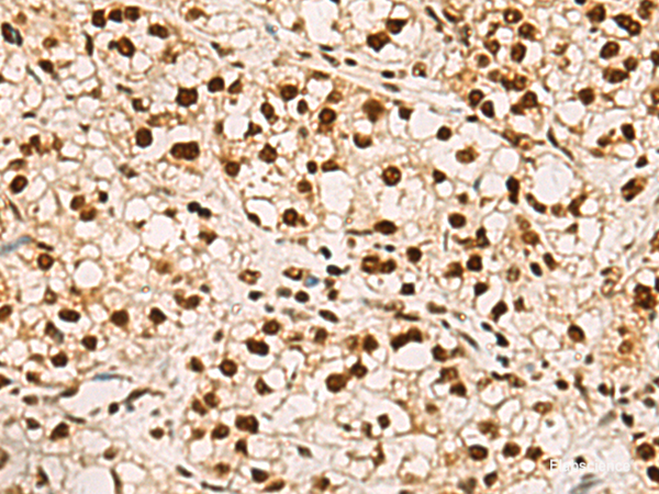 Immunohistochemistry of paraffin-embedded Human liver cancer tissue using ELF5 Polyclonal Antibody at dilution of 1:75(×200)