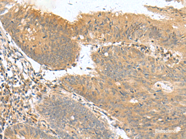 Immunohistochemistry of paraffin-embedded Human colorectal cancer tissue using HHIPL2 Polyclonal Antibody at dilution of 1:50(×200)