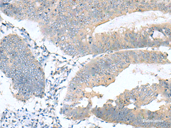 Immunohistochemistry of paraffin-embedded Human colorectal cancer tissue using KRCC1 Polyclonal Antibody at dilution of 1:60(×200)