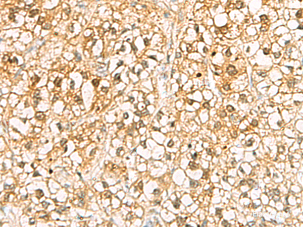 Immunohistochemistry of paraffin-embedded Human liver cancer tissue using C11orf54 Polyclonal Antibody at dilution of 1:70(×200)