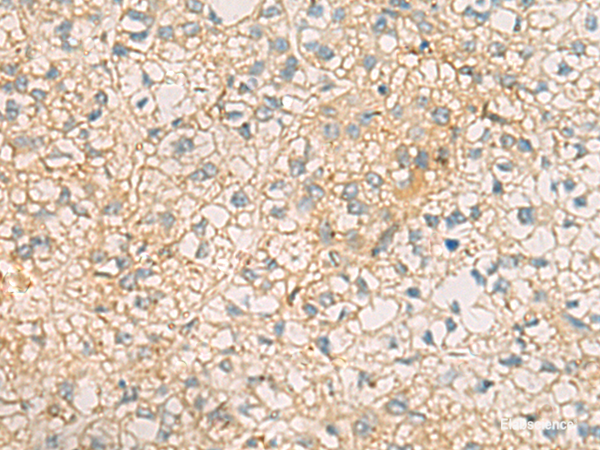 Immunohistochemistry of paraffin-embedded Human liver cancer tissue using MRPL9 Polyclonal Antibody at dilution of 1:60(×200)