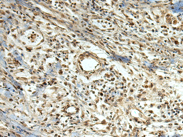Immunohistochemistry of paraffin-embedded Human breast cancer tissue using MLF1 Polyclonal Antibody at dilution of 1:105(×200)