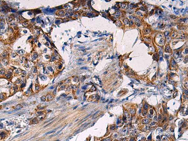 Immunohistochemistry of paraffin-embedded Human esophagus cancer tissue using RITA1 Polyclonal Antibody at dilution of 1:50(×200)