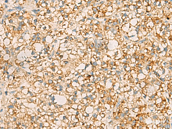 Immunohistochemistry of paraffin-embedded Human liver cancer tissue using PDCL Polyclonal Antibody at dilution of 1:40(×200)