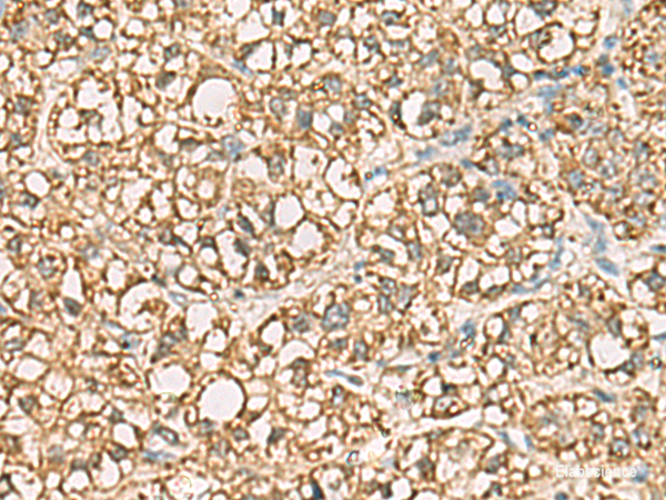 Immunohistochemistry of paraffin-embedded Human liver cancer tissue using VTA1 Polyclonal Antibody at dilution of 1:85(×200)