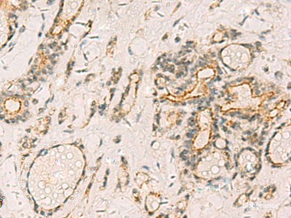 Immunohistochemistry of paraffin-embedded Human thyroid cancer tissue using HORMAD2 Polyclonal Antibody at dilution of 1:35(×200)