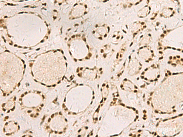 Immunohistochemistry of paraffin-embedded Human thyroid cancer tissue using SAP30BP Polyclonal Antibody at dilution of 1:45(×200)